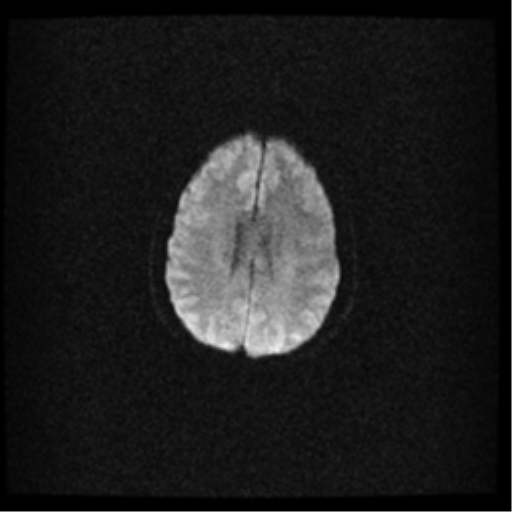 File:Acute pontine infarct from vertebral artery dissection (Radiopaedia 34111-35370 Axial DWI 15).png