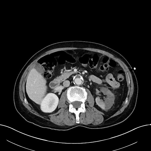 File:Acute renal infarction (Radiopaedia 59375-66736 Axial C+ portal venous phase 42).jpg