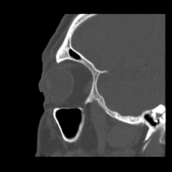 Acute sinusitis (Radiopaedia 23161-23215 Sagittal bone window 15).jpg
