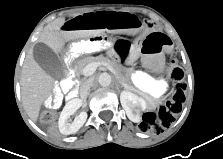 Acute small bowel (ileal) volvulus (Radiopaedia 71740-82139 Axial C+ portal venous phase 72).jpg