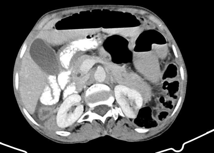 Acute small bowel (ileal) volvulus (Radiopaedia 71740-82139 Axial C+ portal venous phase 75).jpg
