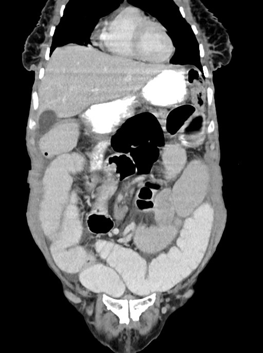 Acute small bowel (ileal) volvulus (Radiopaedia 71740-82139 Coronal C+ portal venous phase 34).jpg