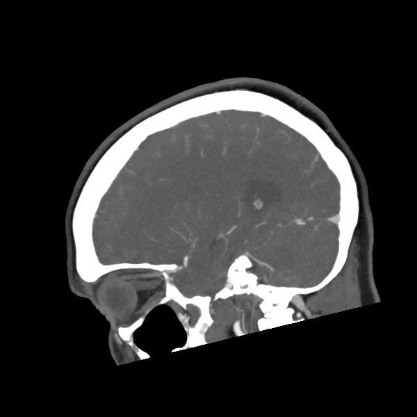 File:Acute subarachnoid hemorrhage and accessory anterior cerebral artery (Radiopaedia 69231-79009 Sagittal C+ arterial phase 49).jpg
