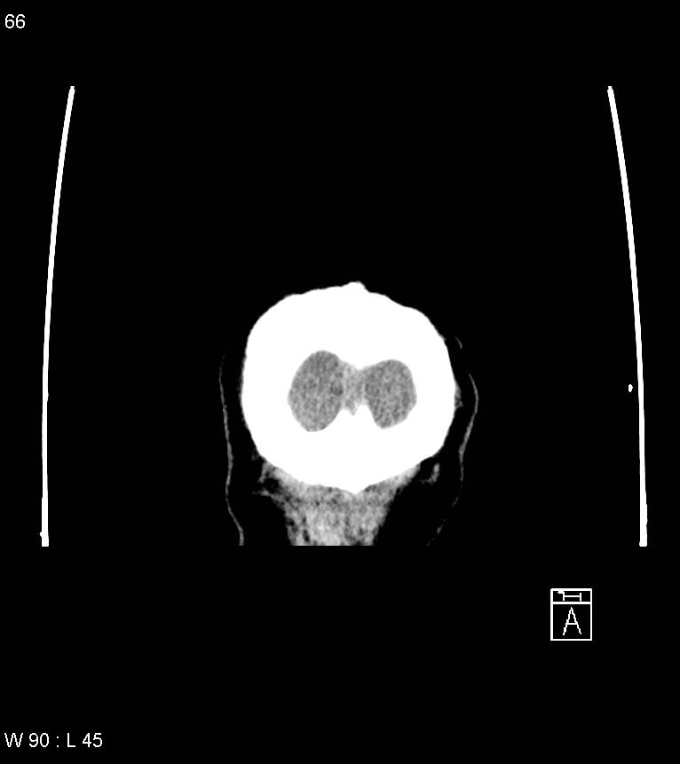 Acute subdural hematoma with myelofibrosis (Radiopaedia 52582-58494 Coronal non-contrast 57).jpg
