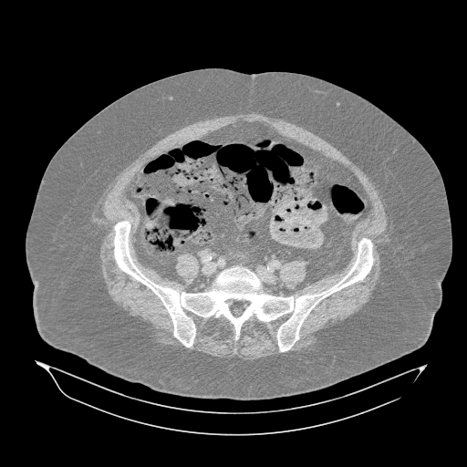 Acute superior mesenteric artery occlusion (Radiopaedia 51288-56960 Axial lung window 52).jpg