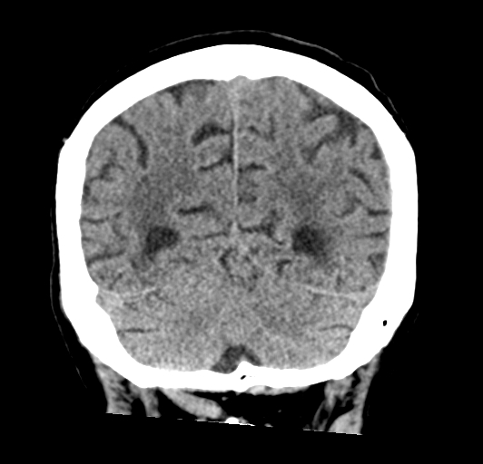 File:Acute traumatic subdural hematoma (Radiopaedia 82921-97257 Coronal non-contrast 65).jpg