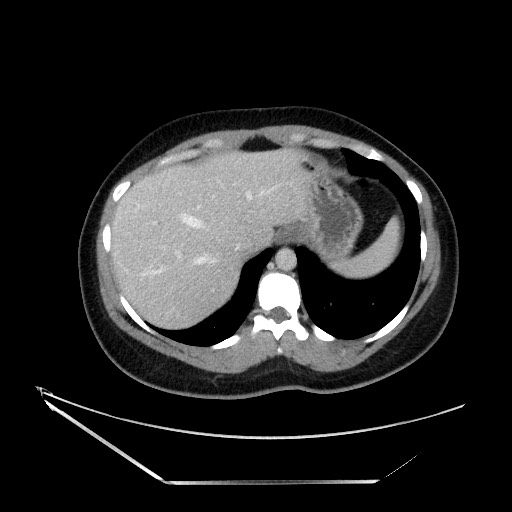 File:Acute uncomplicated appendicitis (Radiopaedia 73704-84499 Axial C+ portal venous phase 25).jpg