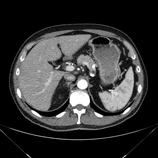 File:Adenocarcinoma of the lung (Radiopaedia 59871-67325 Axial C+ arterial phase 94).jpg