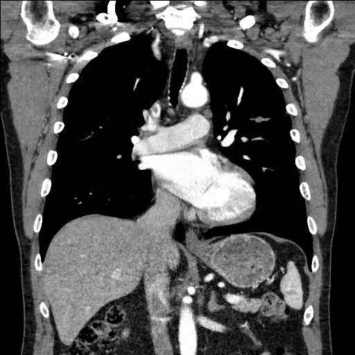 Adenocarcinoma of the lung (Radiopaedia 59871-67325 Coronal C+ arterial phase 34).jpg