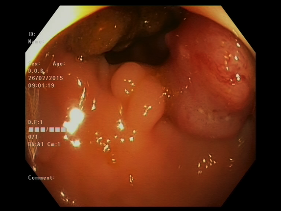 File:Adenocarcioma of rectum- T1 lesion (Radiopaedia 36921-38553 A 1).png