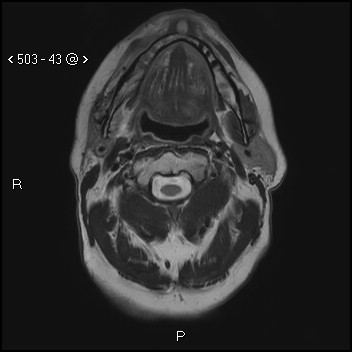 File:Adenoid cystic carcinoma of the parotid gland (Radiopaedia 20128).jpg