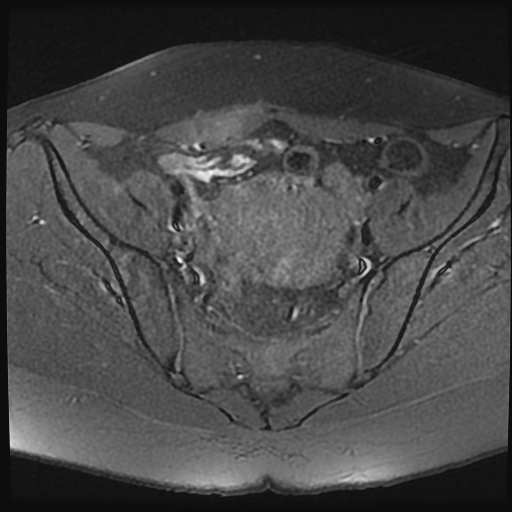 File:Adenomyosis-scar endometriosis (Radiopaedia 65863-75022 Axial T1 fat sat 9).jpg