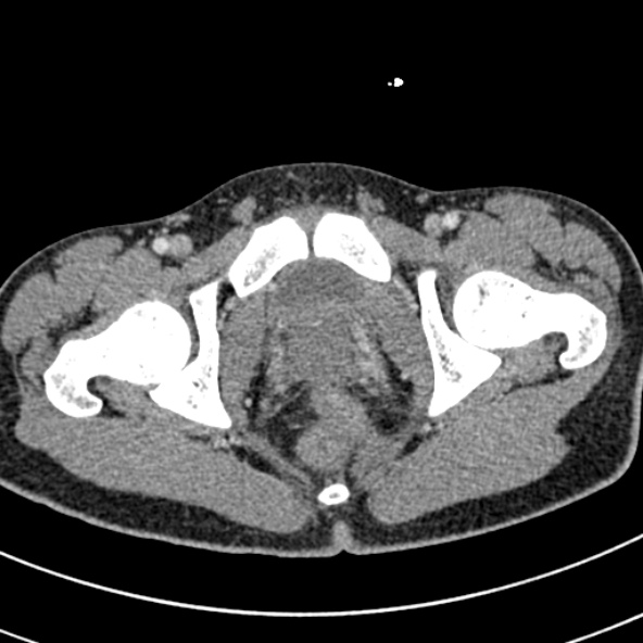 Adhesional small bowel obstruction (Radiopaedia 52107-57980 Axial C+ portal venous phase 125).jpg