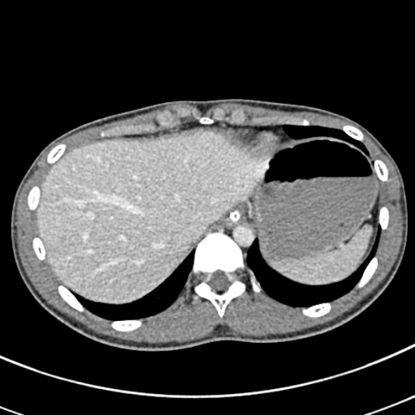 Adhesional small bowel obstruction (Radiopaedia 52107-57980 Axial C+ portal venous phase 15).jpg