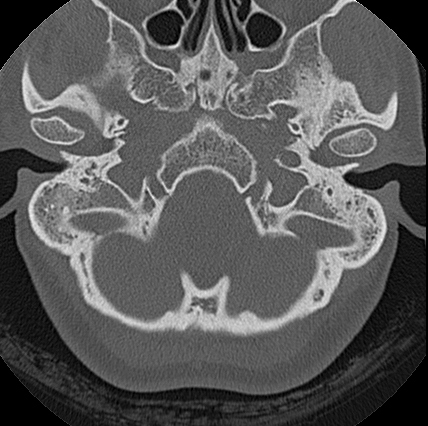 File:Adhesive chronic otitis media (Radiopaedia 14270-14148 Axial bone window 18).jpg