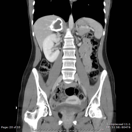 File:Adrenal calcification (Radiopaedia 55755-62314 Coronal C+ portal venous phase 20).jpg