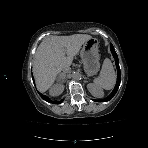 File:Adrenal collision tumor (ACT) (Radiopaedia 48462-53379 Axial non-contrast 13).jpg