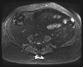 Adrenal cortical carcinoma (Radiopaedia 64017-72770 Axial DWI 84).jpg