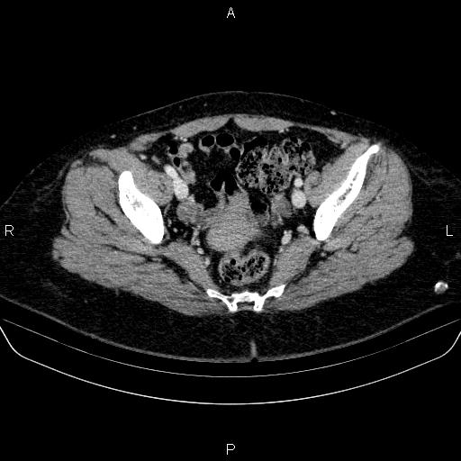 Adrenal cortical carcinoma (Radiopaedia 84882-100379 Axial C+ portal venous phase 83).jpg