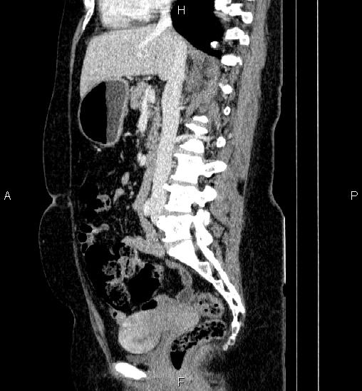 File:Adrenal cortical carcinoma (Radiopaedia 84882-100379 Sagittal C+ portal venous phase 43).jpg