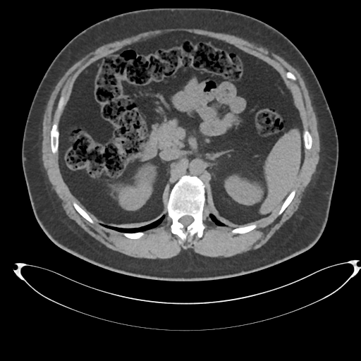Adrenal cyst (Radiopaedia 45625-49778 Axial non-contrast 38).png