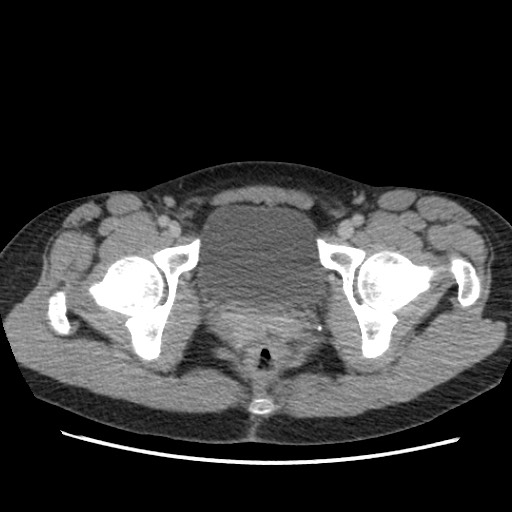 Adrenal cyst (Radiopaedia 64869-73813 Axial C+ portal venous phase 77).jpg