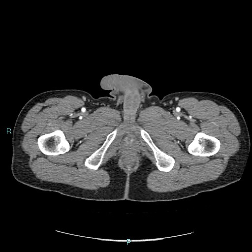 File:Adrenal cystic lymphangioma (Radiopaedia 83161-97534 Axial C+ arterial phase 109).jpg