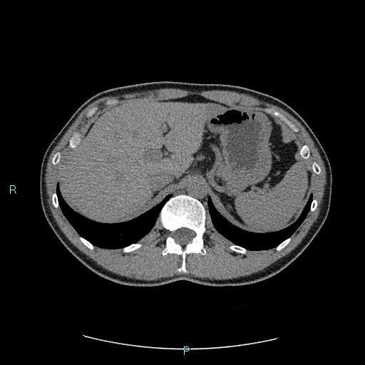 Adrenal cystic lymphangioma (Radiopaedia 83161-97534 Axial non-contrast 25).jpg