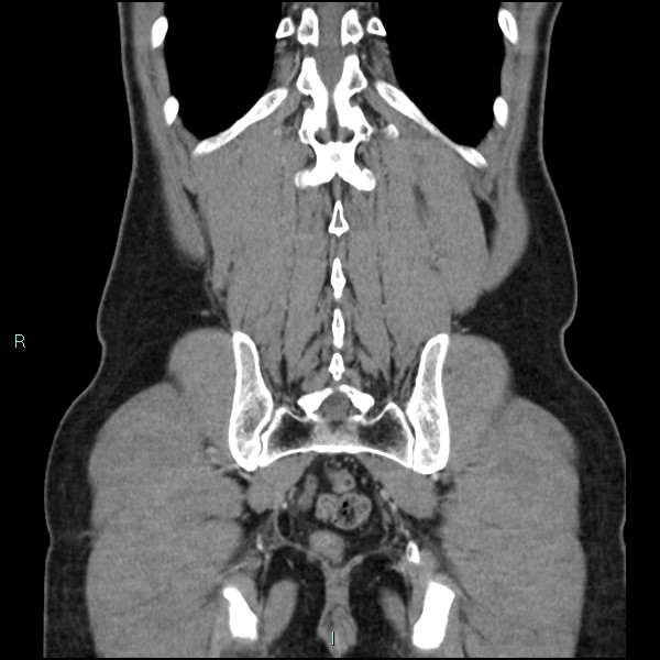 Adrenal cystic lymphangioma (Radiopaedia 83161-97534 Coronal C+ portal venous phase 63).jpg