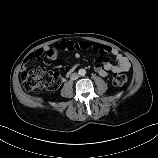 Adrenal lymphoma (Radiopaedia 73730-84529 Axial C+ portal venous phase 72).jpg