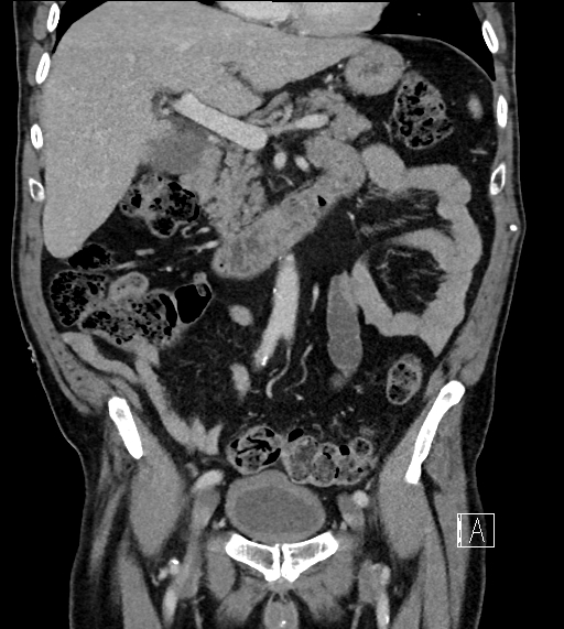 Adrenal lymphoma (Radiopaedia 73730-84529 Coronal C+ portal venous phase 33).jpg