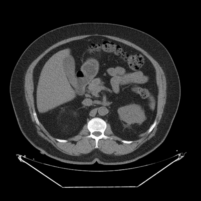 Adrenal myelolipoma (Radiopaedia 26278-26407 Axial non-contrast 22).jpg