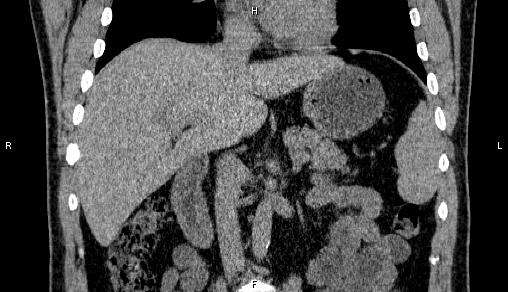 Adrenal myelolipoma (Radiopaedia 84321-99619 Coronal non-contrast 40).jpg