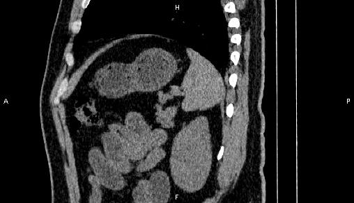 Adrenal myelolipoma (Radiopaedia 84321-99619 Sagittal non-contrast 85).jpg