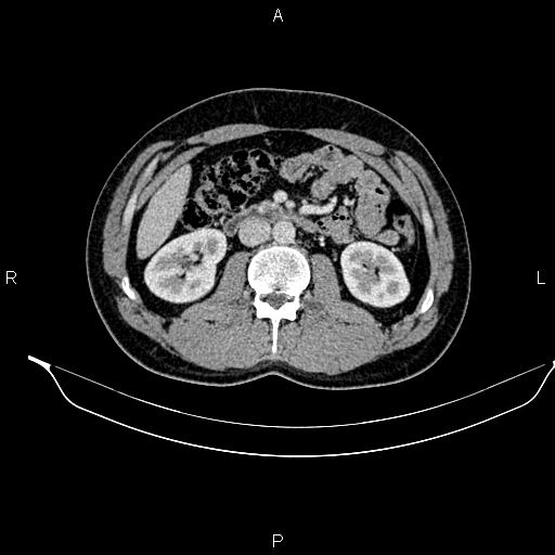 Adrenal myelolipoma (Radiopaedia 87794-104246 Axial renal cortical phase 49).jpg