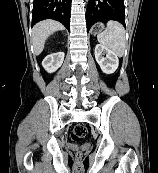 Adrenal myelolipoma (Radiopaedia 87794-104246 Coronal renal cortical phase 47).jpg