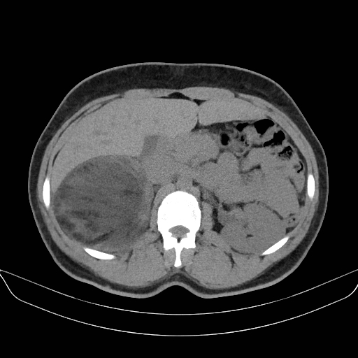 Adrenal myelolipoma - bilateral (Radiopaedia 74805-85810 Axial non-contrast 27).jpg
