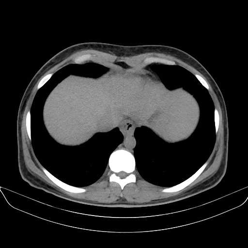 Adrenal myelolipoma - bilateral (Radiopaedia 74805-85810 Axial non-contrast 7).jpg