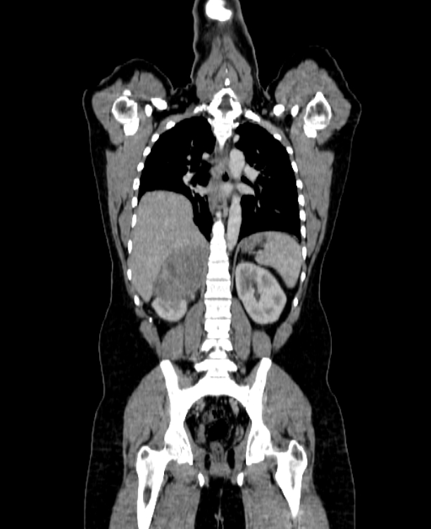 Adrenocortical carcinoma (Radiopaedia 80134-93438 Coronal C+ portal venous phase 111).jpg