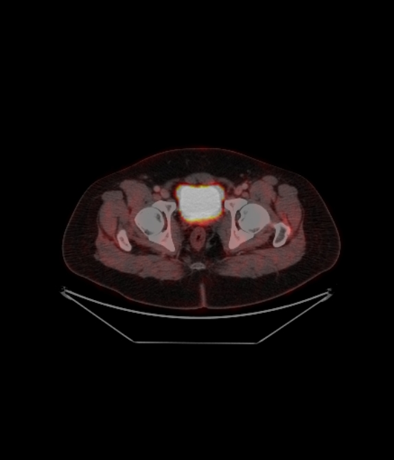 Adrenocortical carcinoma (Radiopaedia 80134-93440 ِAxial 249).jpg