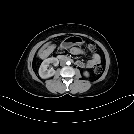 Adrenocortical carcinoma (Radiopaedia 87281-103569 Axial C+ arterial phase 43).jpg