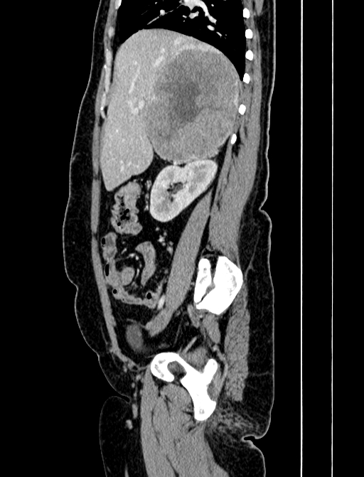 Adrenocortical carcinoma (Radiopaedia 87281-103569 Sagittal C+ portal venous phase 90).jpg