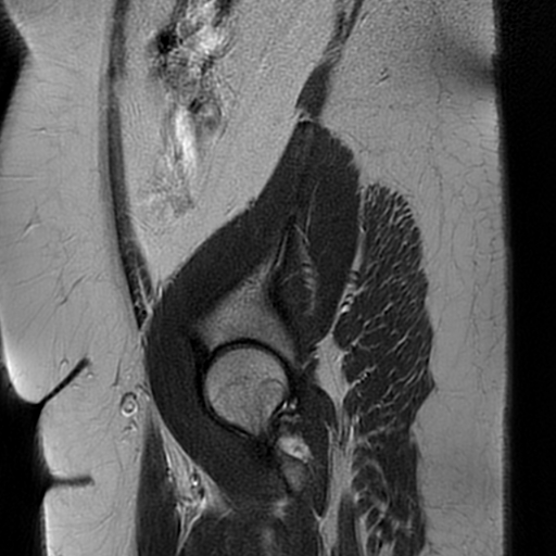 File:Adult granulosa cell tumor of the ovary (Radiopaedia 64991-73953 Sagittal T2 1).jpg