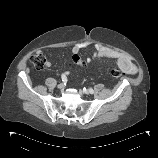 Adult ileal intussusception with secondary obstruction (Radiopaedia 30395-31051 Axial C+ portal venous phase 58).jpg