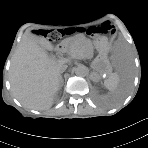 Advanced metastatic lung cancer (Radiopaedia 48910-53954 Axial non-contrast 59).png