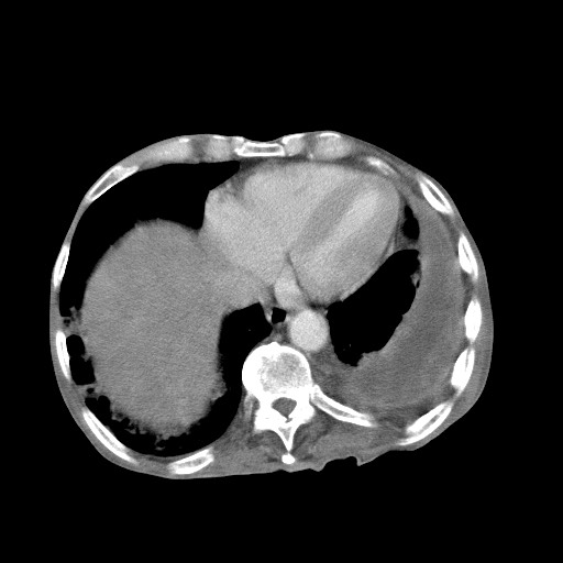 Aggressive lung cancer with cardiac metastases, pulmonary artery tumor thrombus, and Budd-Chiari (Radiopaedia 60320-67981 A 44).jpg
