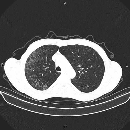 Air bronchogram in pneumonia (Radiopaedia 85719-101512 Axial lung window 21).jpg