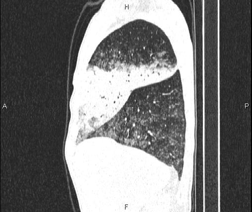Air bronchogram in pneumonia (Radiopaedia 85719-101512 Sagittal lung window 24).jpg
