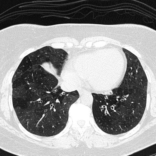 Air trapping in small airway disease (Radiopaedia 61685-69694 Axial lung window 126).jpg