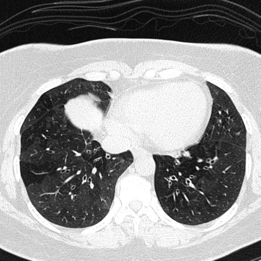 Air trapping in small airway disease (Radiopaedia 61685-69694 Axial lung window 129).jpg
